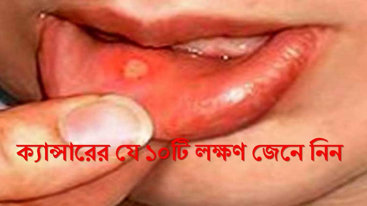 জেনে নিন ক্যান্সারের যে ১০টি লক্ষণ সহজেই সনাক্ত করা যায় !!